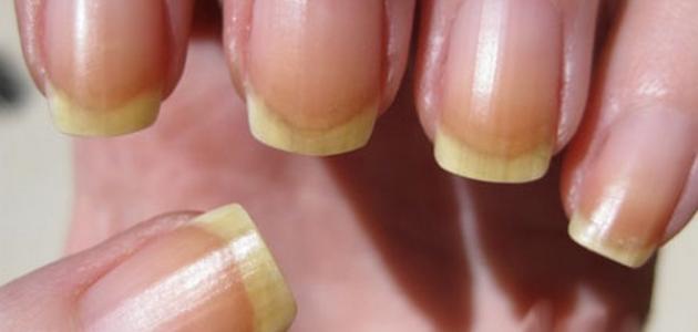 إليكم أسباب اصفرار الأظافر؟
